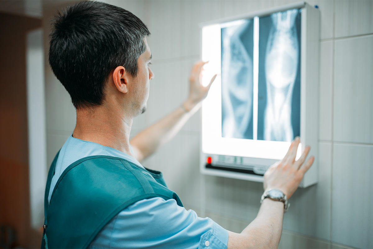 Imagerie médicale d'une personne souffrant d'ostéophytose